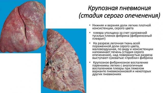 Особенности лечения крупозной пневмонии