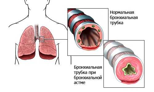Можно ли ходить в баню при бронхиальной астме и чем это может обернуться