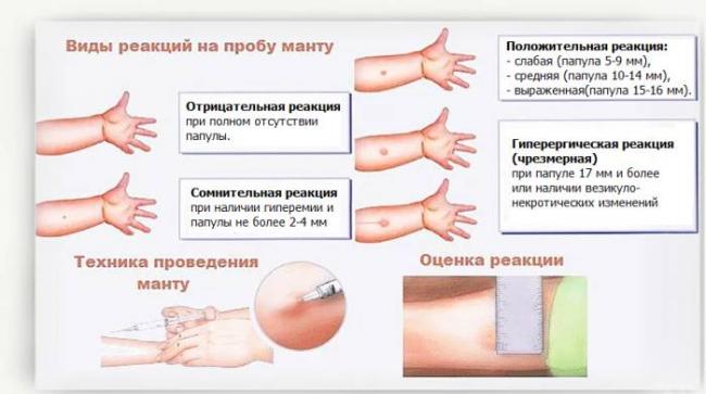 Можно ли мочить пробу манту?
