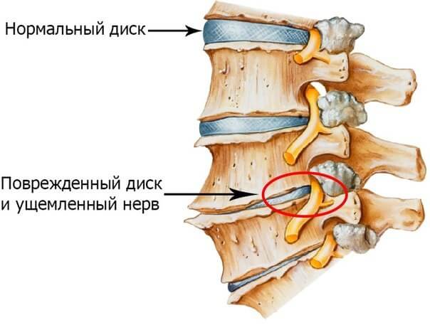 Как лечить спондилит позвоночника