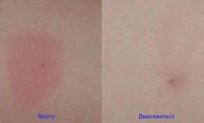 Диаскинтест во время простуды