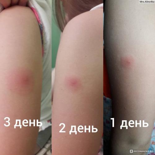 Нет рубца от бцж