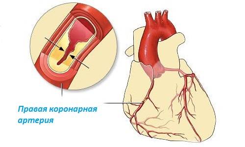 Лечение антагонистами кальция больных ишемической болезнью сердца