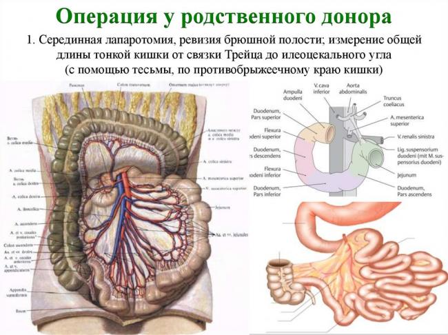 Резекция кишечника: тонкой и толстой кишки (операция удаления её части органа)