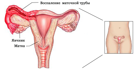 Активный хронический цервицит
