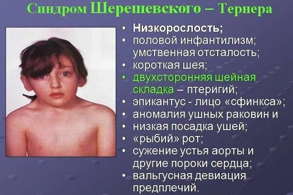 Инфантилизм