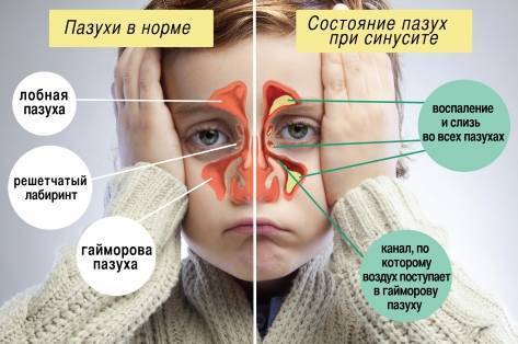 Симптомы и лечение гайморита у взрослых