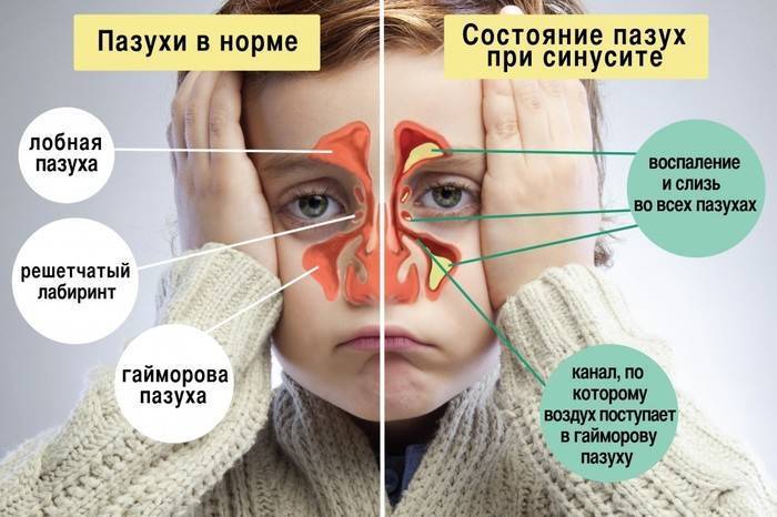 Антибиотик при гайморите взрослым название препаратов
