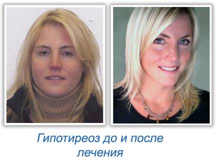 Причины возникновения микседемы щитовидной железы и её симптомы