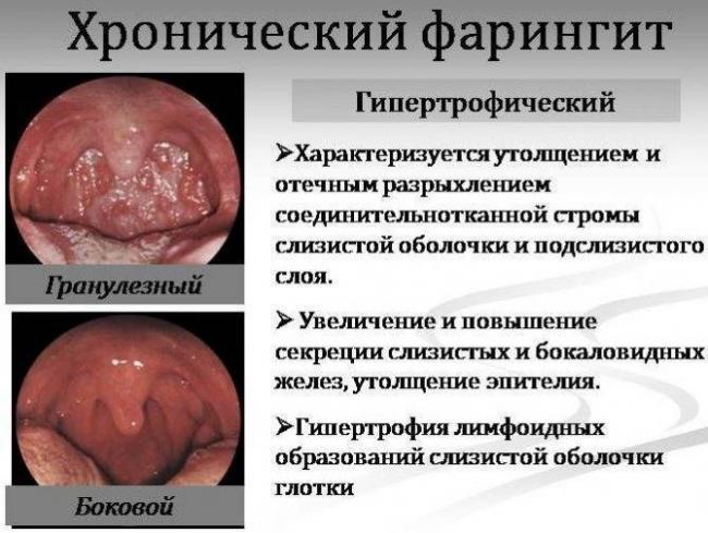 Хронический фарингит: симптомы и лечение