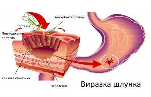 Бактерии в моче при беременности: причины отклонений и расшифровка, что показывает анализ на бакпосев