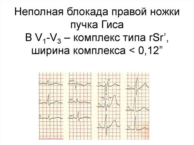 Неполная блокада правой ножки пучка гиса: характеристика, симптомы, диагностика и лечение