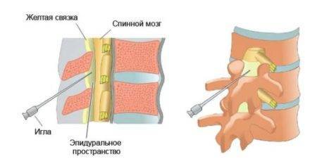 Блокада при грыже поясничного отдела позвоночника
