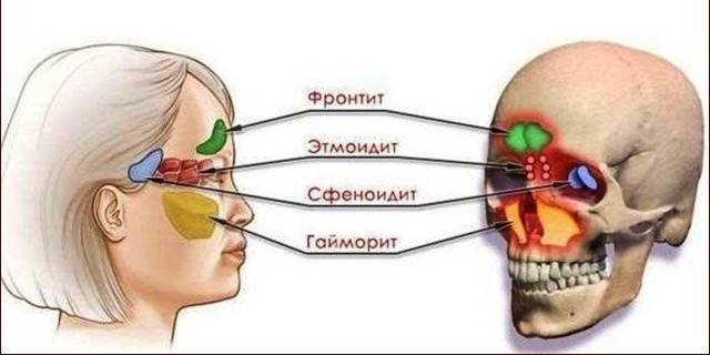 Сфеноидит