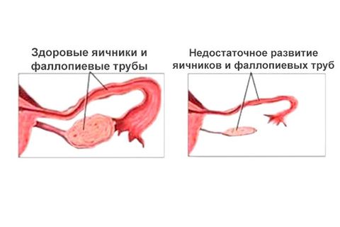 Что такое половой инфантилизм?
