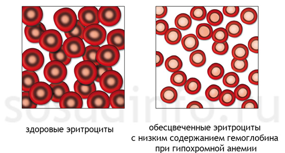 Анемии (малокровие)
