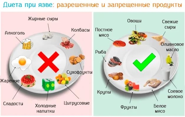 Язва желудка: симптомы, лечение, диета, народные средтва