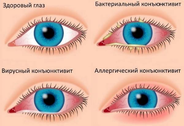 Воспаление века глаза народные средства