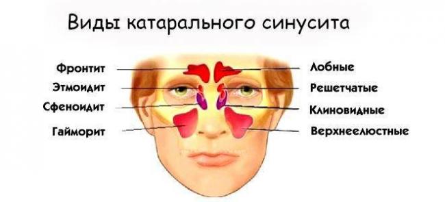 Сфеноидит