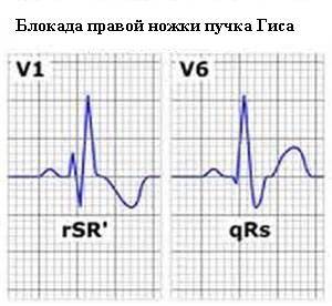 Блокада правой ножки пучка гиса: причины, основные симптомы, методы диагностики, лечение и профилактика