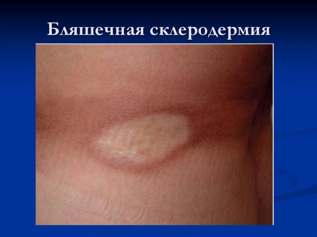 Склеродермия: классификация, симптомы, диагностика, лечение