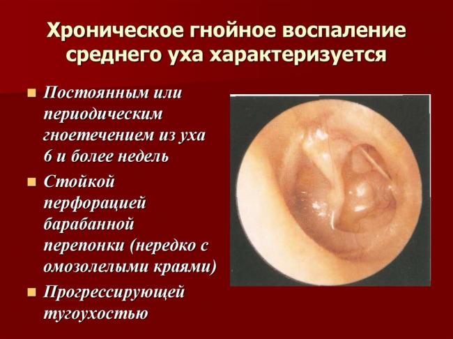 Наружный отит - медицинский справочникмедицинский справочник