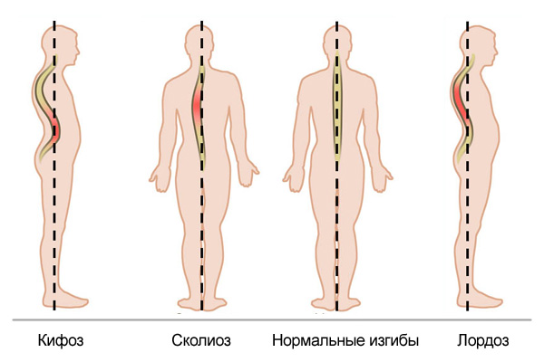 Гипокифоз или сглаженный кифоз грудного отдела позвоночника