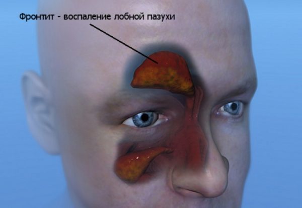 Фронтит