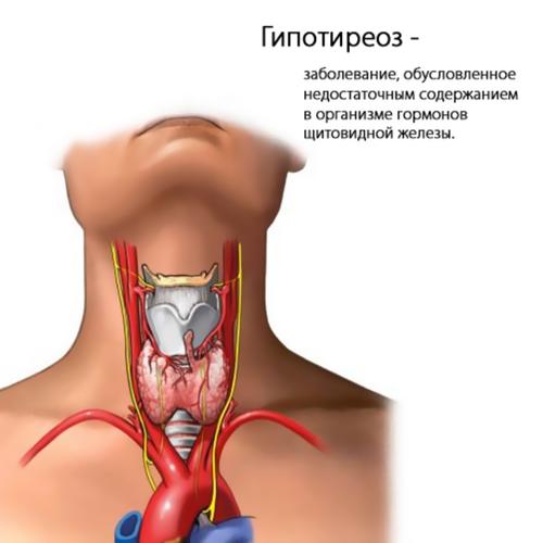 Симптомы гипотиреоза у женщин, лечение щитовидной железы