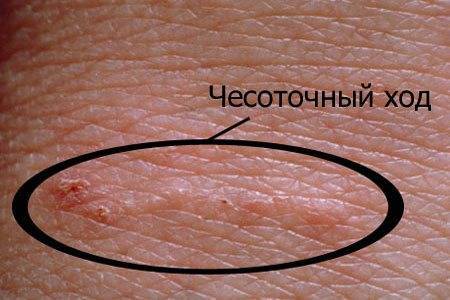Высыпания на грудине у женщин фото