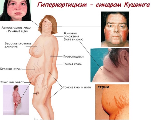 Гидрокортизон (hydrocortisone) в ампулах. цена, инструкция по применению для компрессов, аналоги