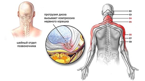 Туберкулезный спондилит – современная диагностика и самое эффективное лечение