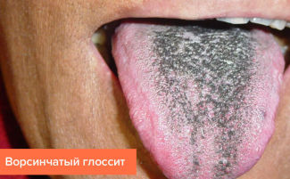 Глоссит: виды, симптомы, причины, лечение у взрослых
