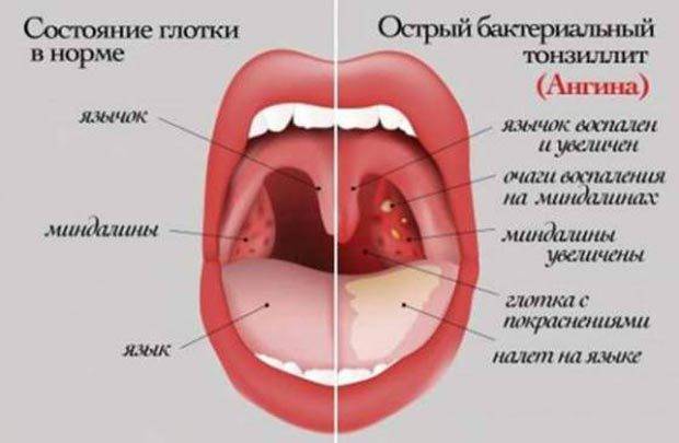 Тонзиллит