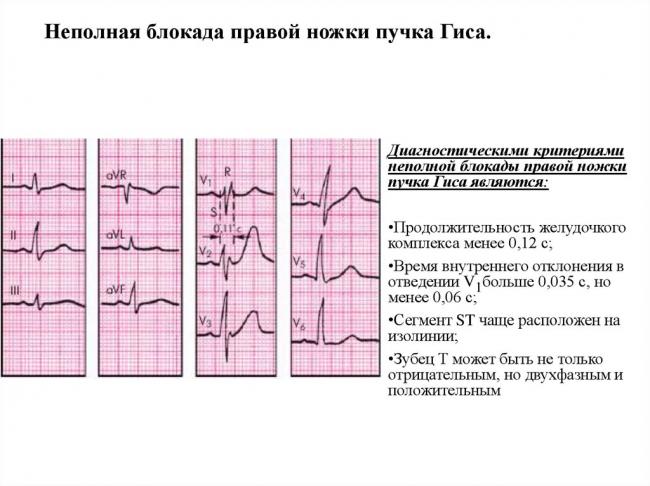 Неполная блокада правой ножки пучка гиса: норма или отклонение?