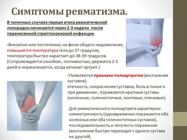 Острая ревматическая лихорадка