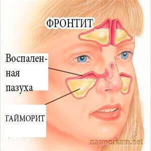 Сфеноидит — воспаление пазух