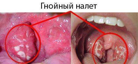 Тонзиллит у взрослых: как лечить и предупредить?