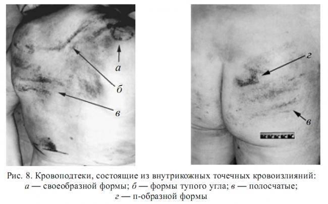 Кровотечение