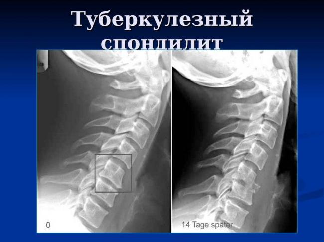 Туберкулезный спондилит позвоночника – дифференциальная диагностика, симптомы, лечение, осложнения туберкулезного спондилита