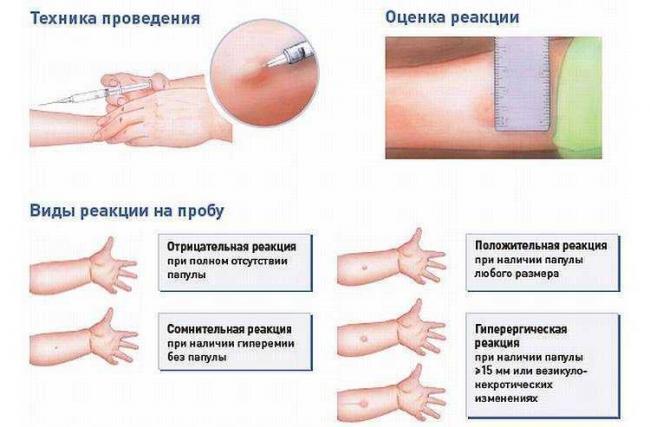 Можно ли делать диаскинтест при насморке и кашле