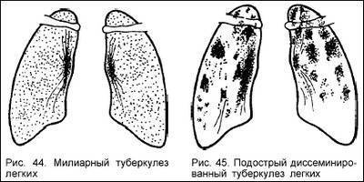 Милиарный туберкулез легких микропрепарат