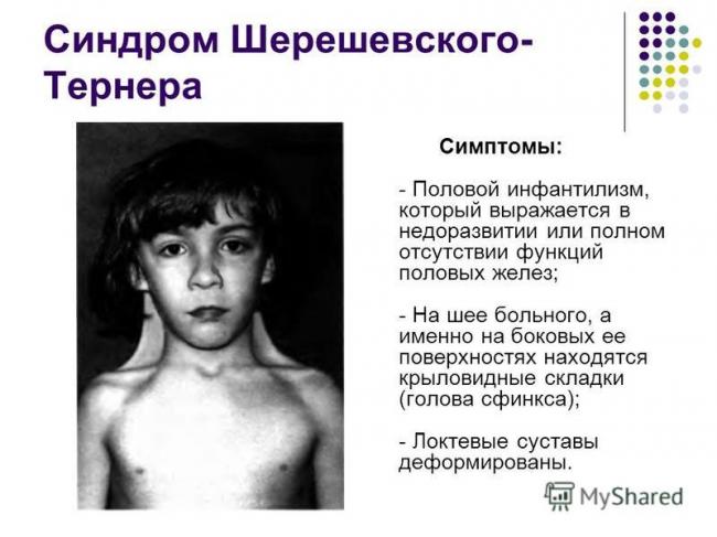 Половой инфантилизм (генитальный инфантилизм): причины, симптомы, лечение