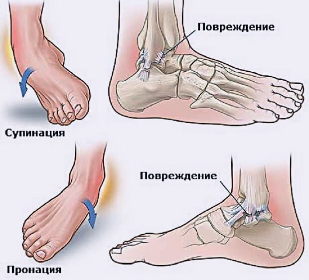 Гематома на ноге после ушиба лечение и причины