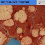 Какой из гепатитов самый опасный?